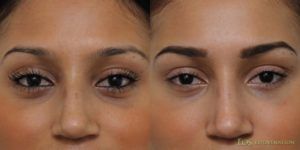 Non-Surgical Eyelid Lift: The Cure for Aging Eyelids