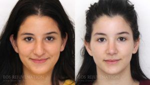 The Real Reasons Behind Revision Rhinoplasty