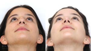 Deviated Septum and Rhinoplasty Correction