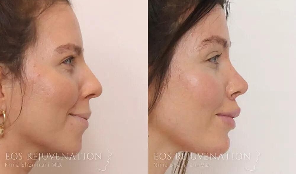 Rhinoplasty Before & After
