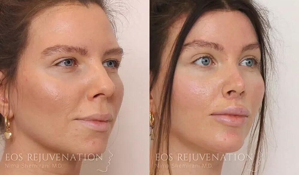 Rhinoplasty Before & After