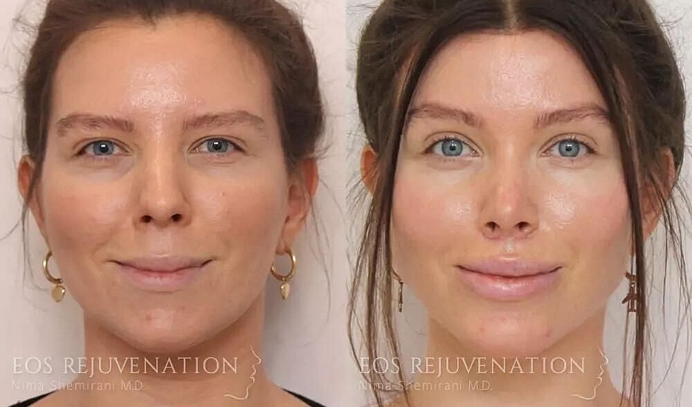 Rhinoplasty Before & After