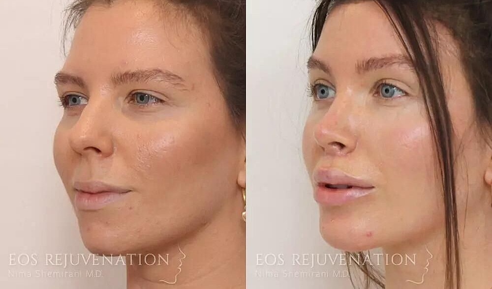 Rhinoplasty Before & After