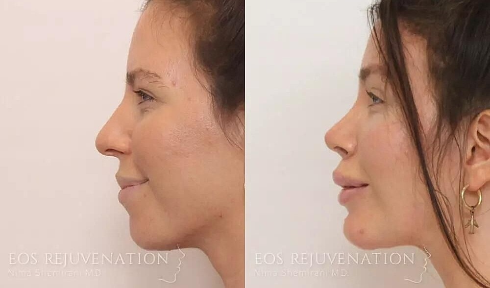 Rhinoplasty Before & After