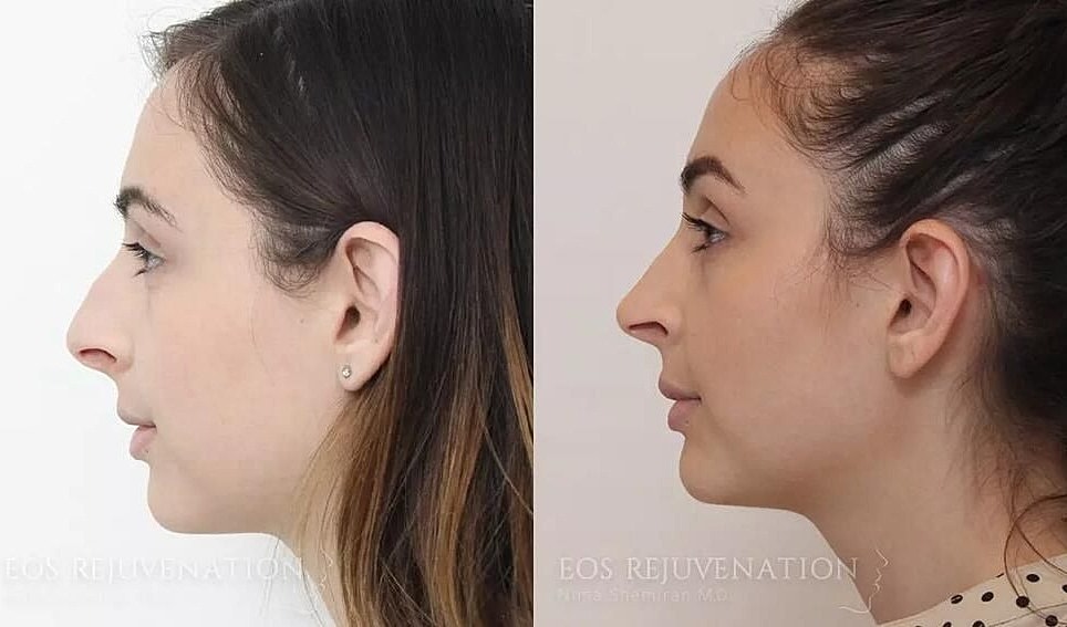 Rhinoplasty Before & After