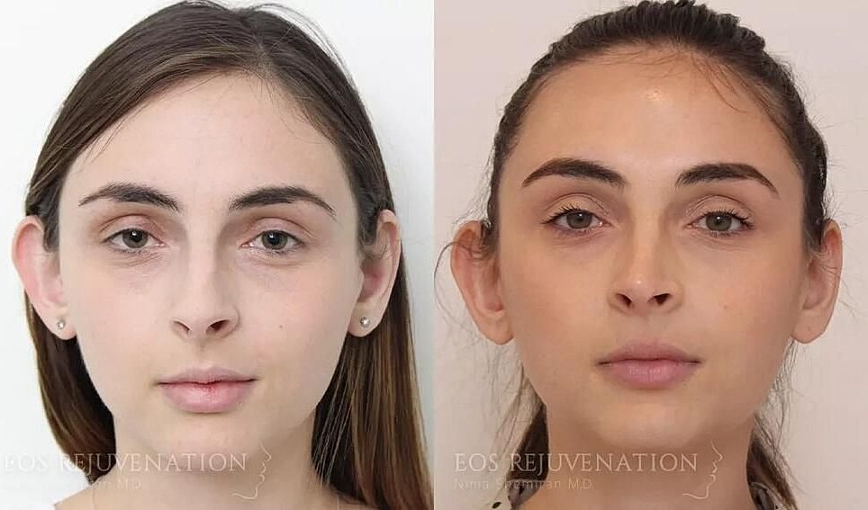 Rhinoplasty Before & After