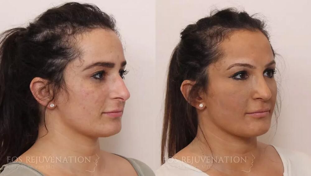 Rhinoplasty Before & After