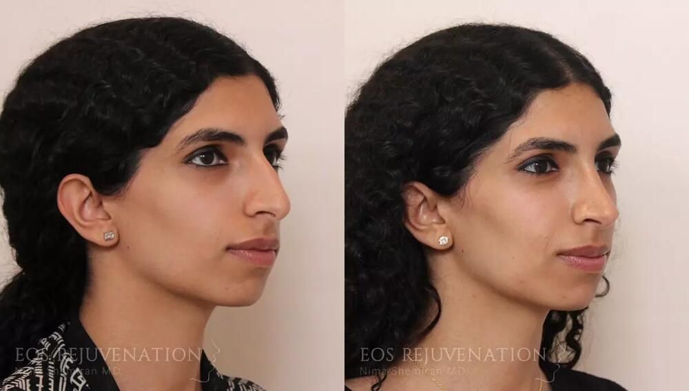 Rhinoplasty Before & After