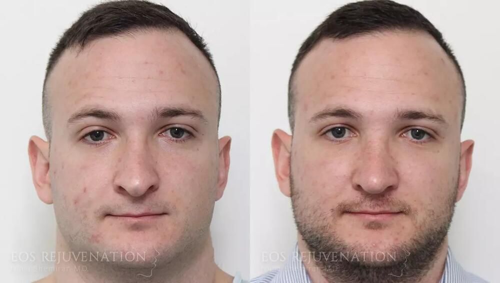Rhinoplasty Before & After