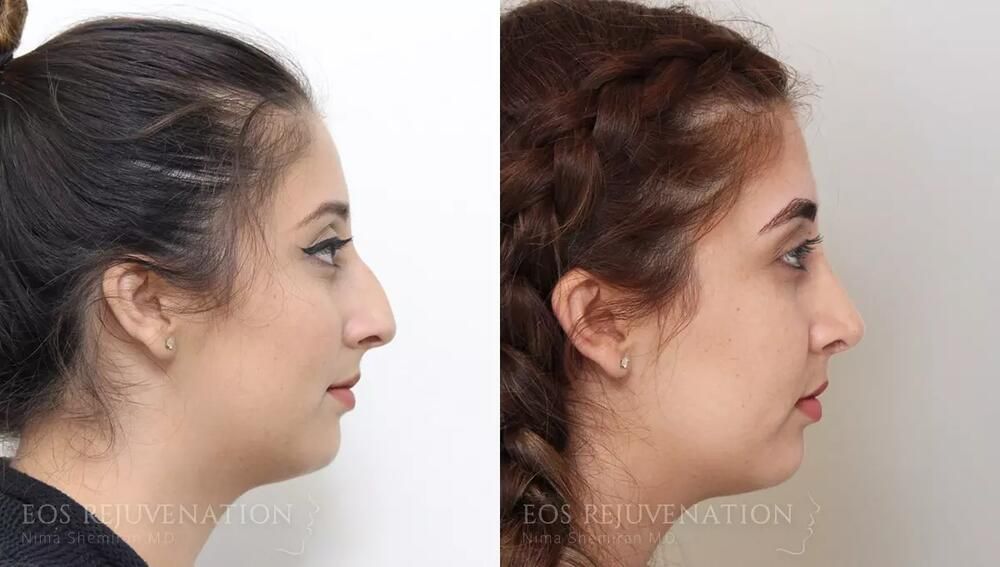 Rhinoplasty Before & After