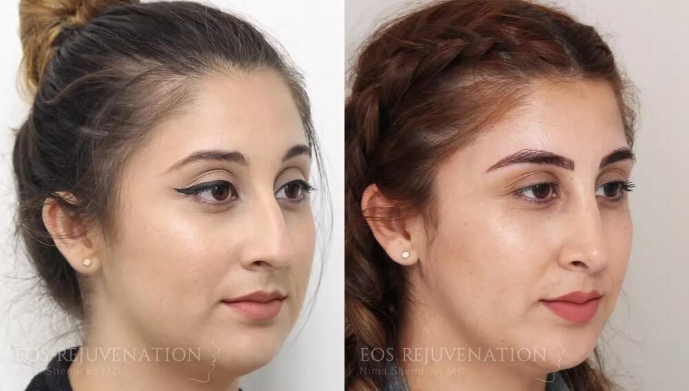 Rhinoplasty Before & After