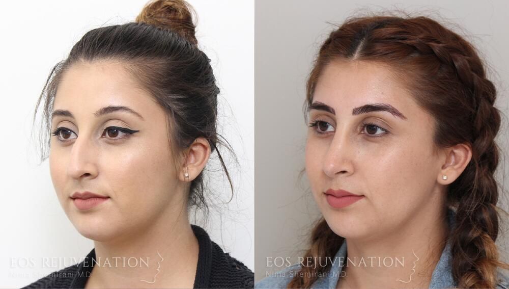 Rhinoplasty Before & After