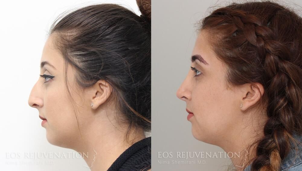 Rhinoplasty Before & After