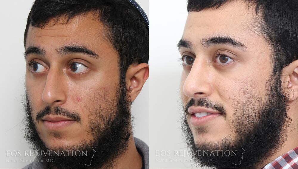 Rhinoplasty Before & After