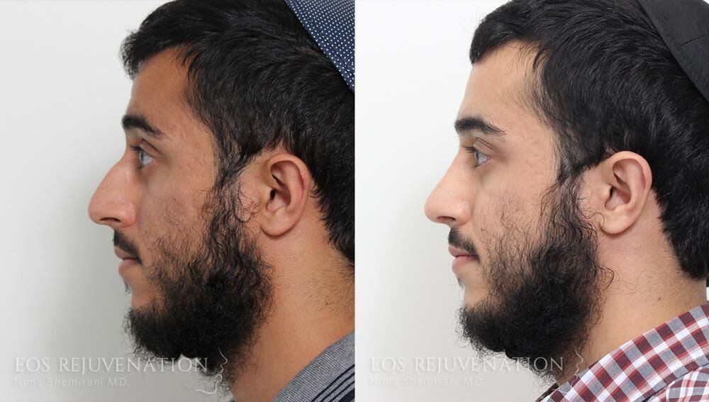 Rhinoplasty Before & After