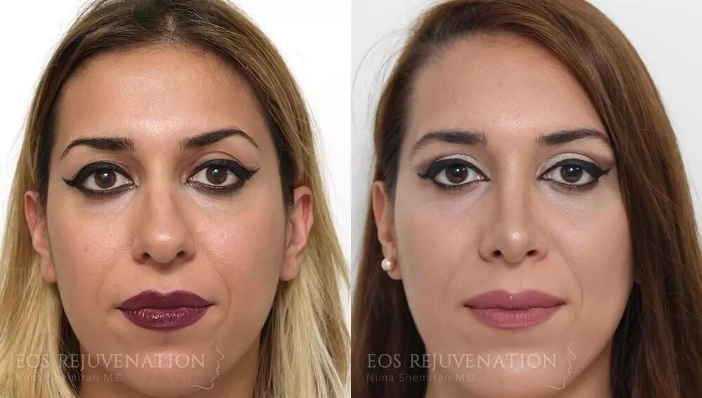 Rhinoplasty Before & After