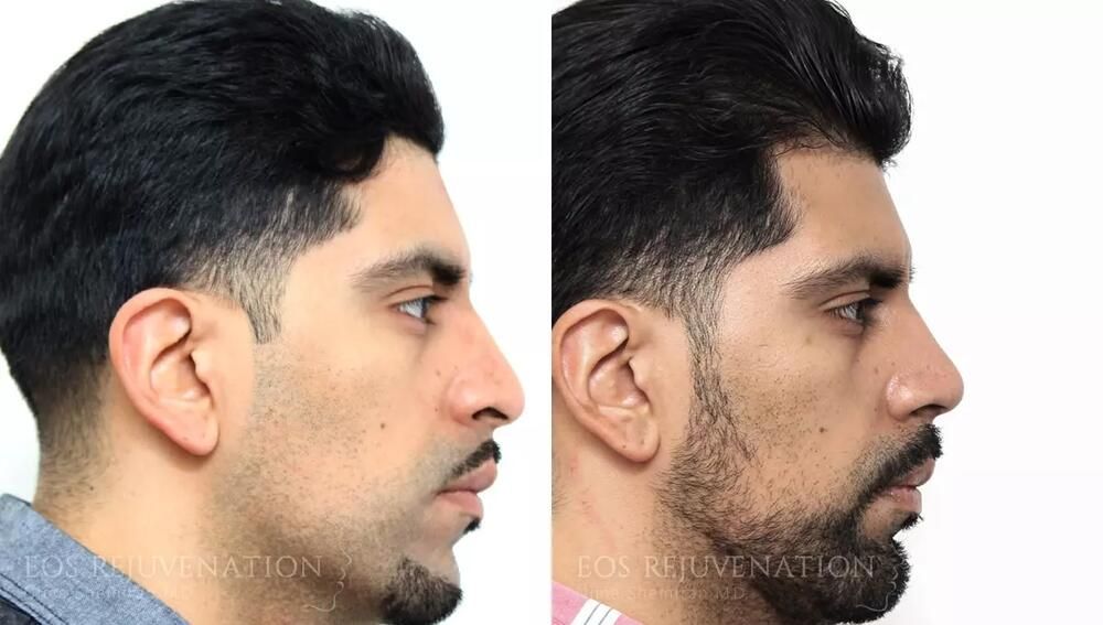 Rhinoplasty Before & After