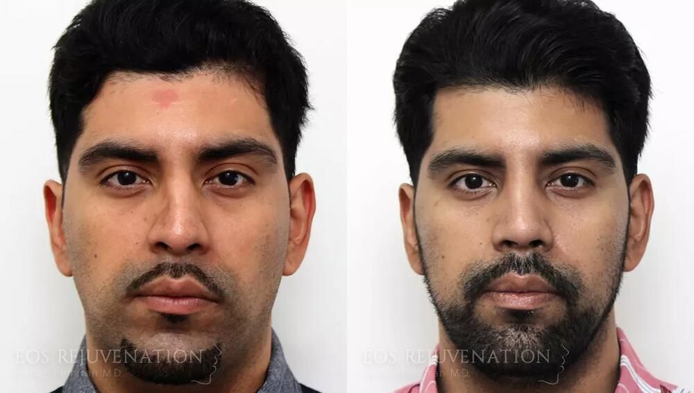 Rhinoplasty Before & After