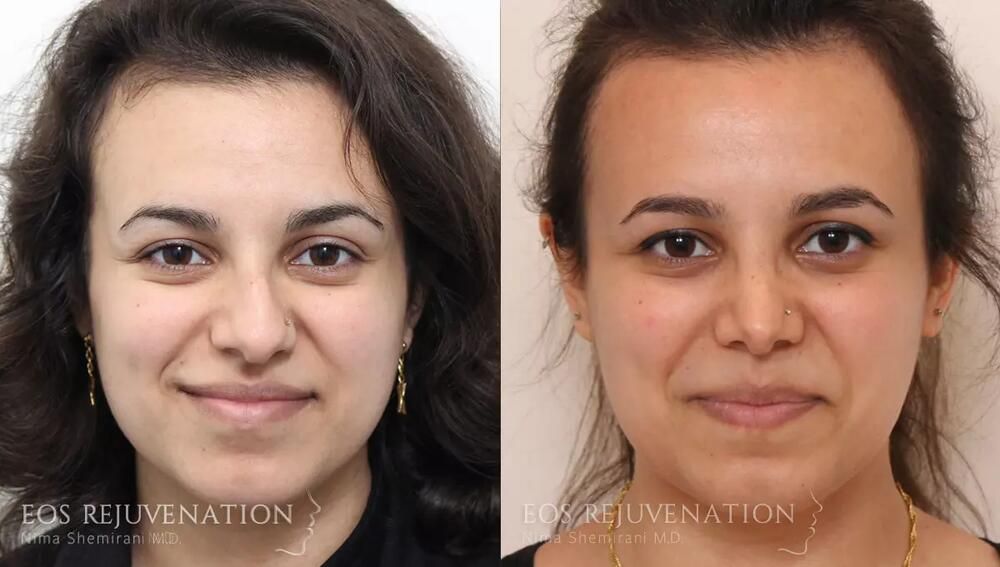 Rhinoplasty Before & After