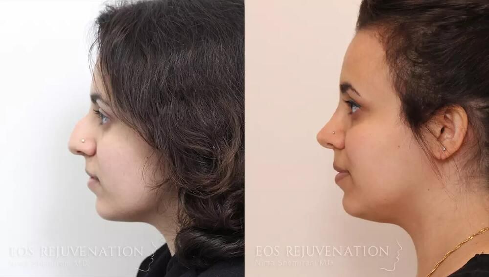 Rhinoplasty Before & After