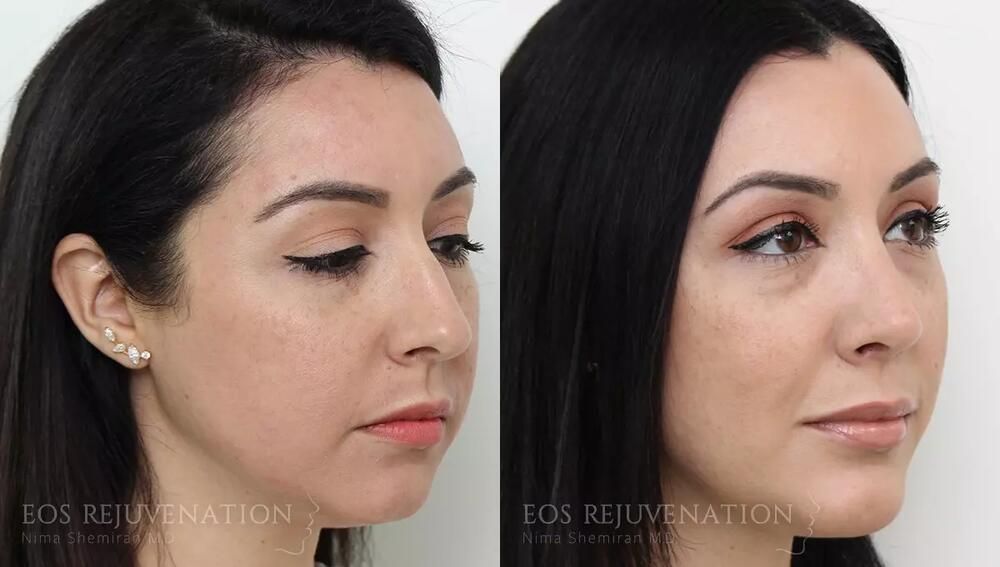 Rhinoplasty Before & After