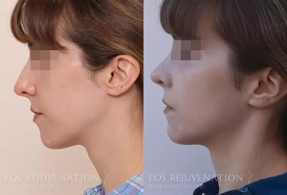 Rhinoplasty Before & After