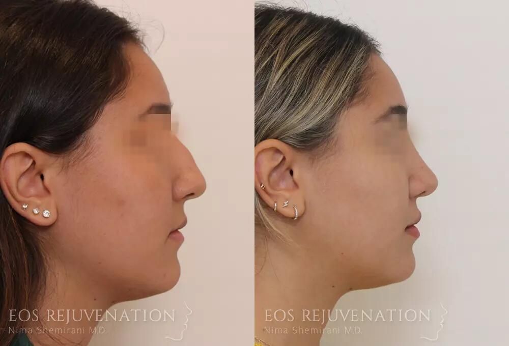 Rhinoplasty Before & After