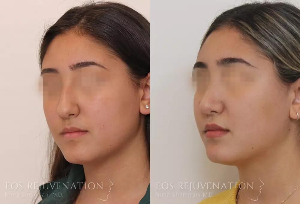 Rhinoplasty Before & After