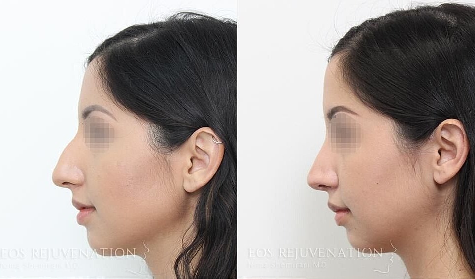 Rhinoplasty Before & After