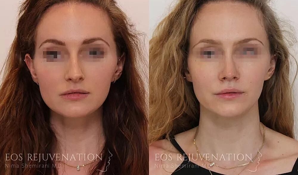 Rhinoplasty Before & After