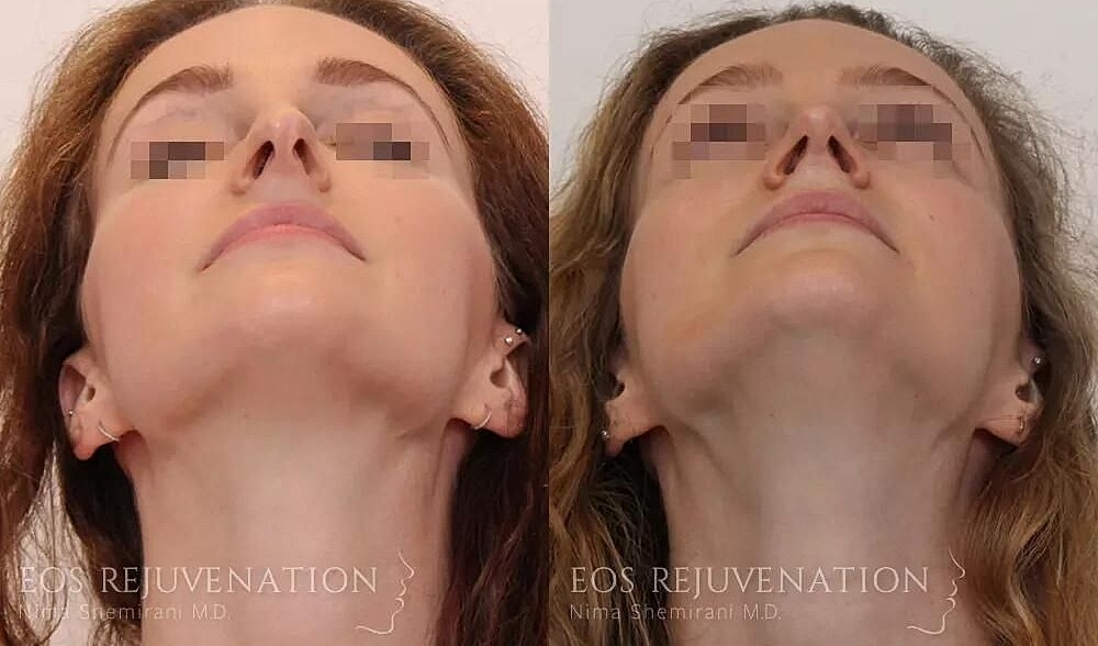 Rhinoplasty Before & After