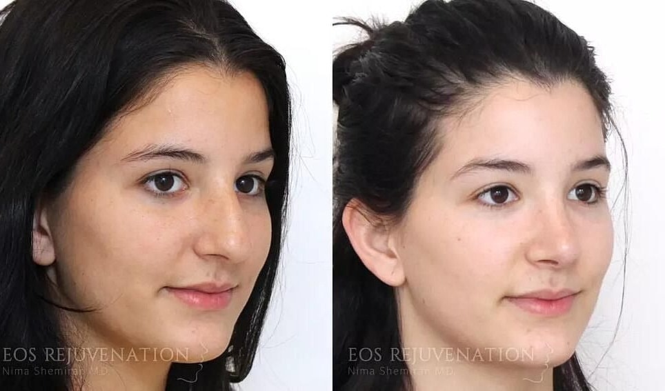 Rhinoplasty Before & After