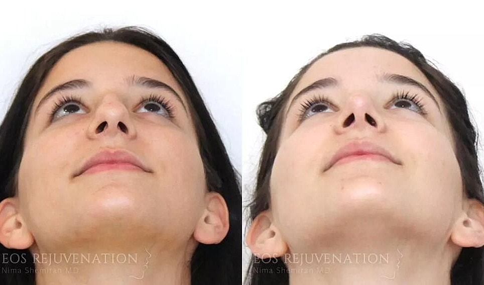 Rhinoplasty Before & After