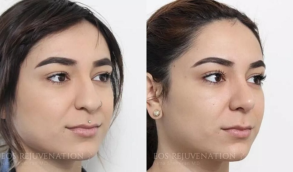 Rhinoplasty Before & After