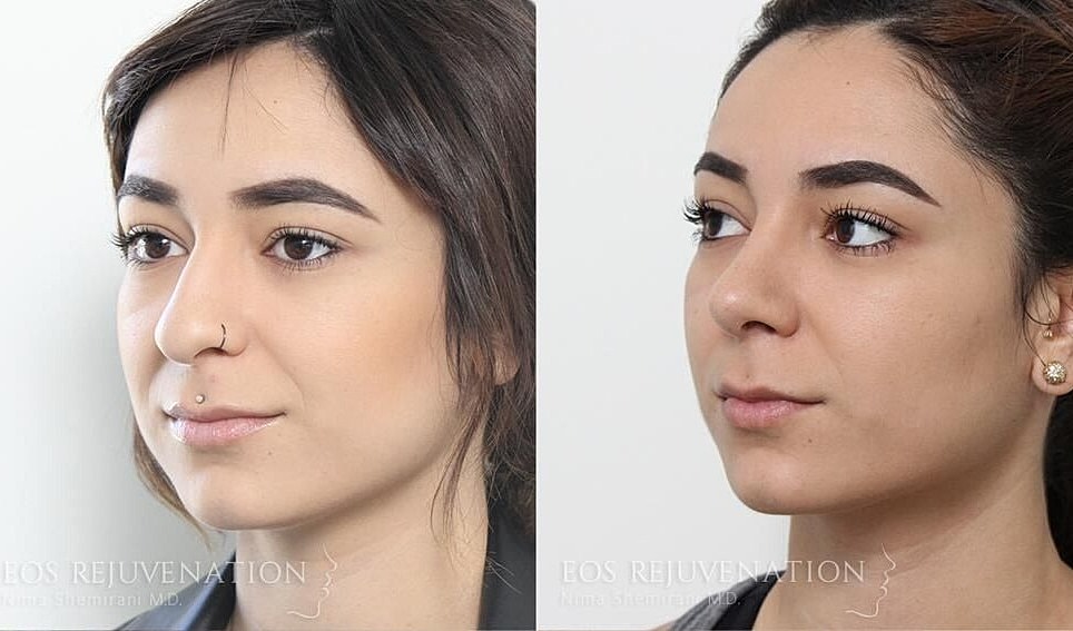 Rhinoplasty Before & After