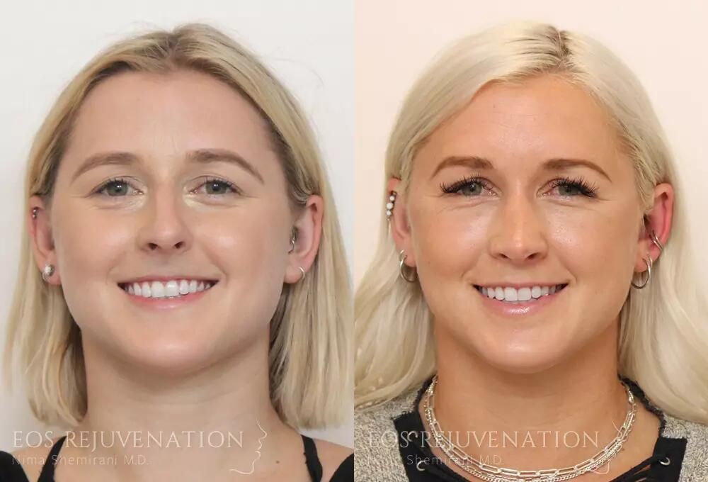 Rhinoplasty Before & After