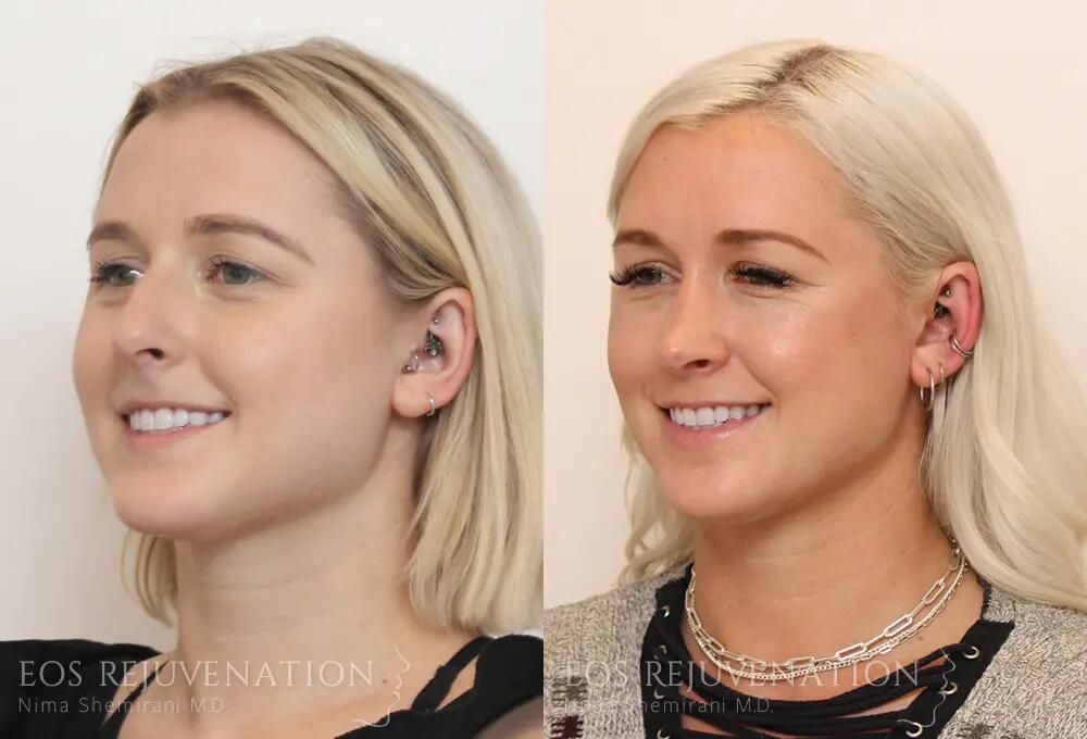 Rhinoplasty Before & After