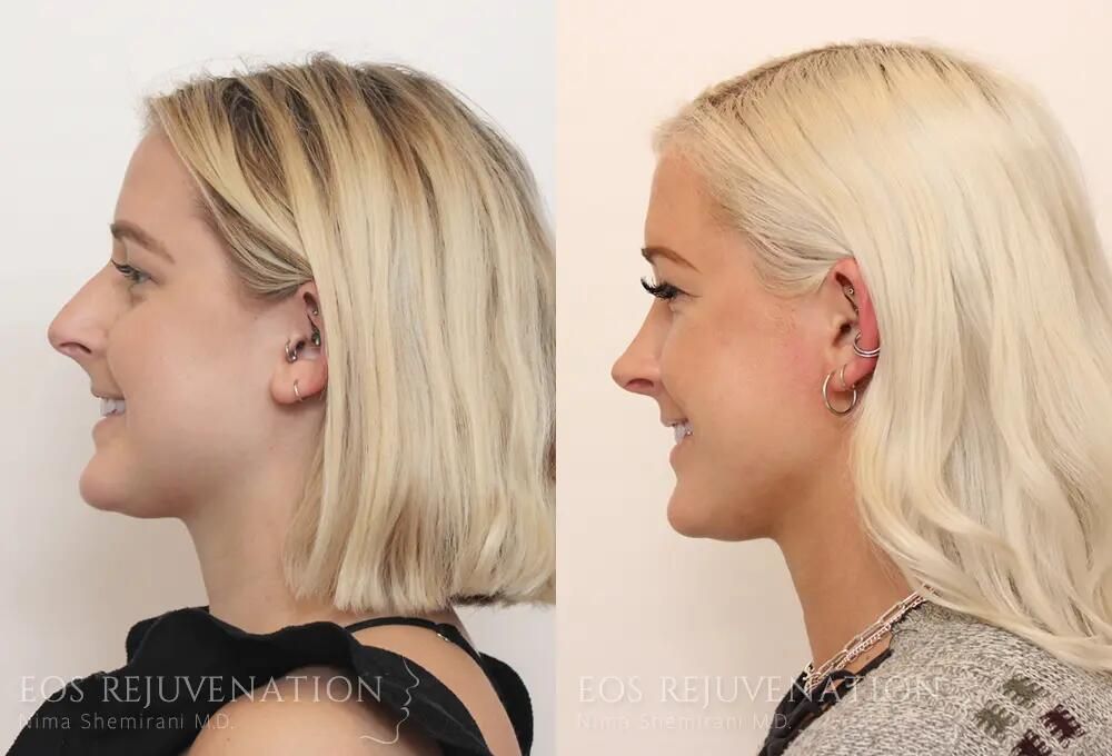 Rhinoplasty Before & After