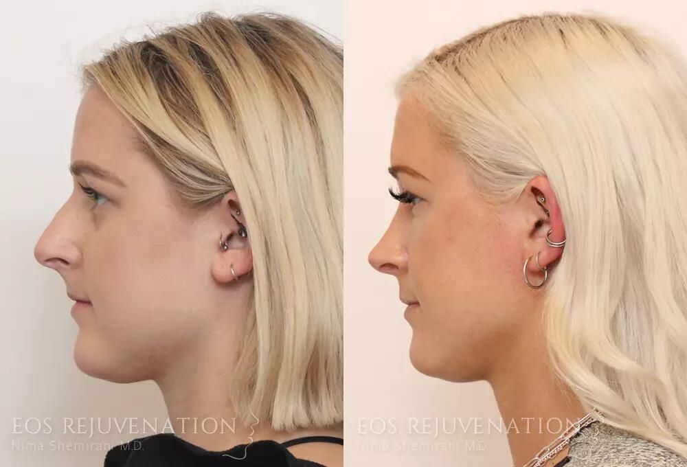 Rhinoplasty Before & After