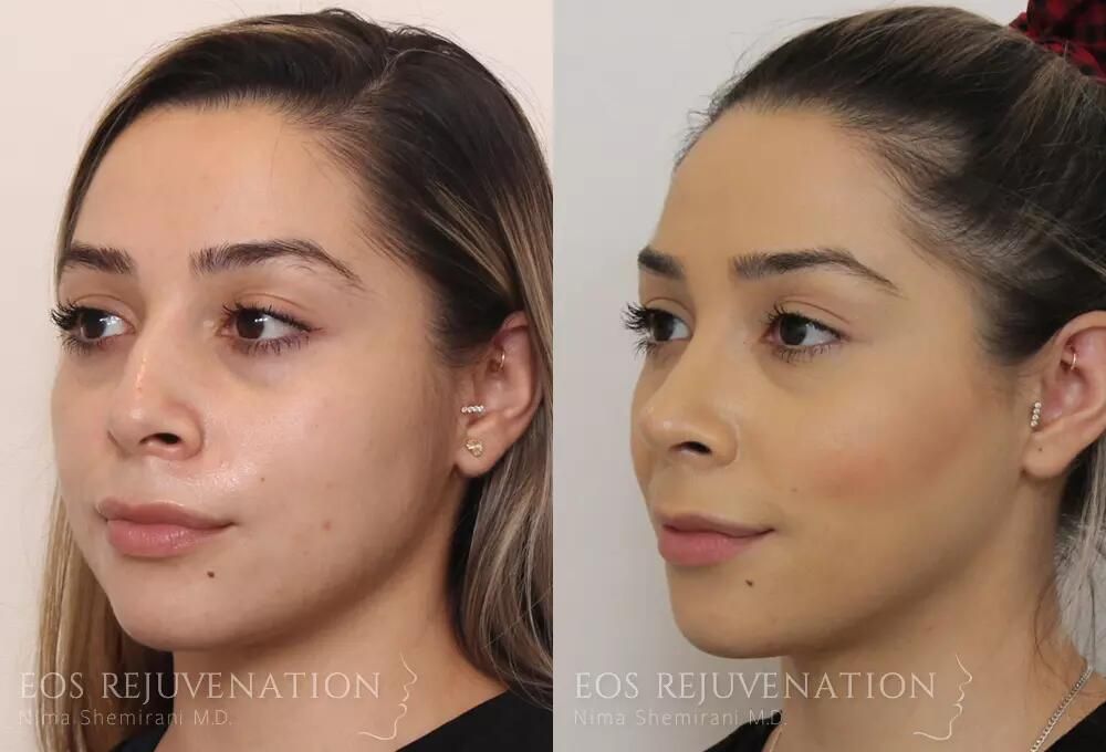 Rhinoplasty Before & After