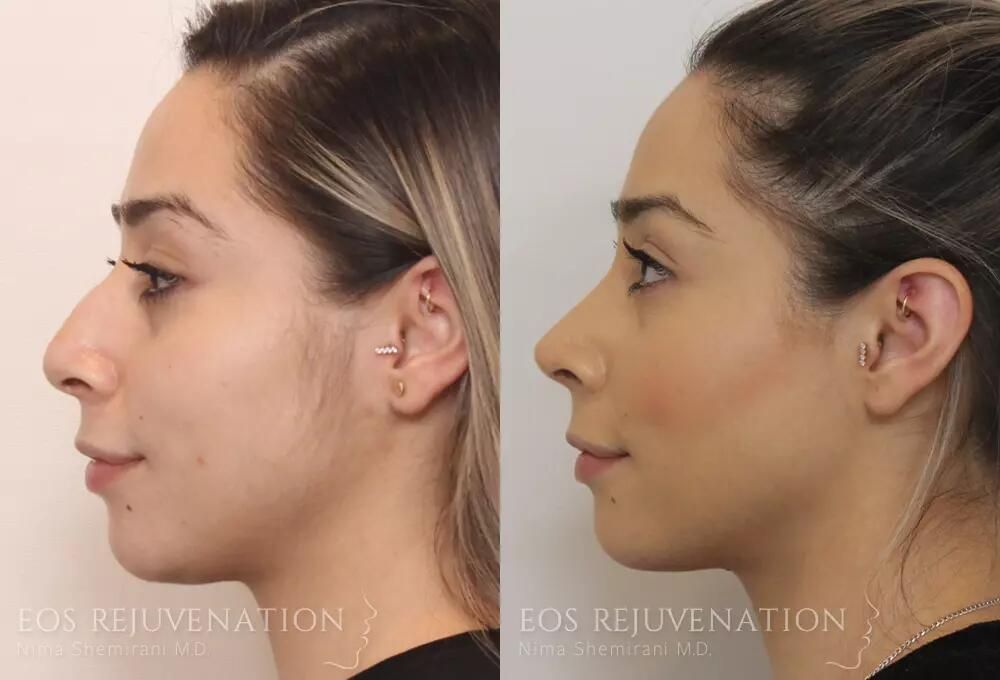 Rhinoplasty Before & After