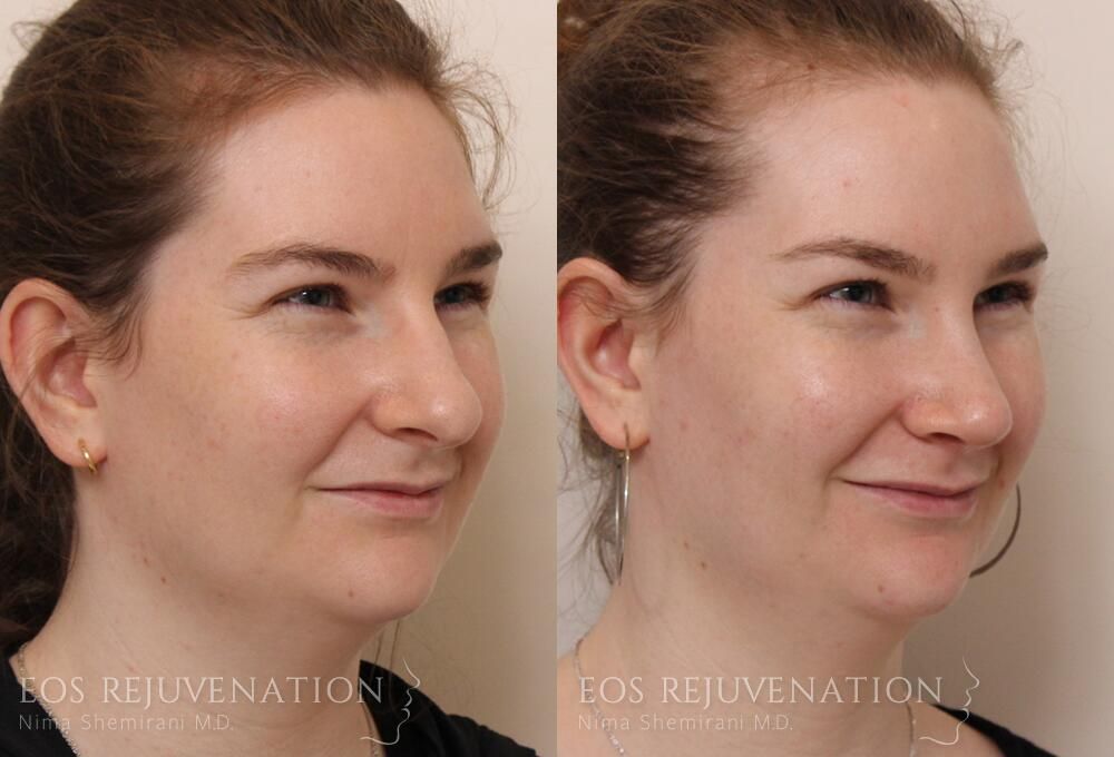 Rhinoplasty Before & After