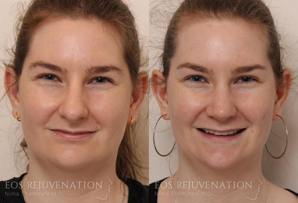 Rhinoplasty Before & After