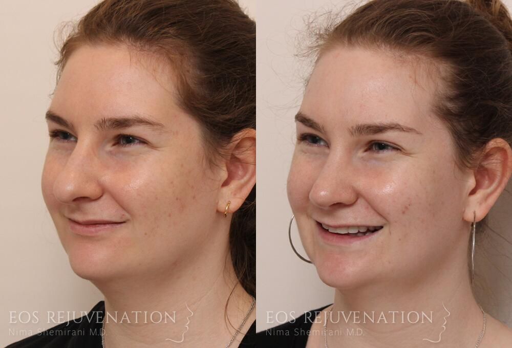 Rhinoplasty Before & After