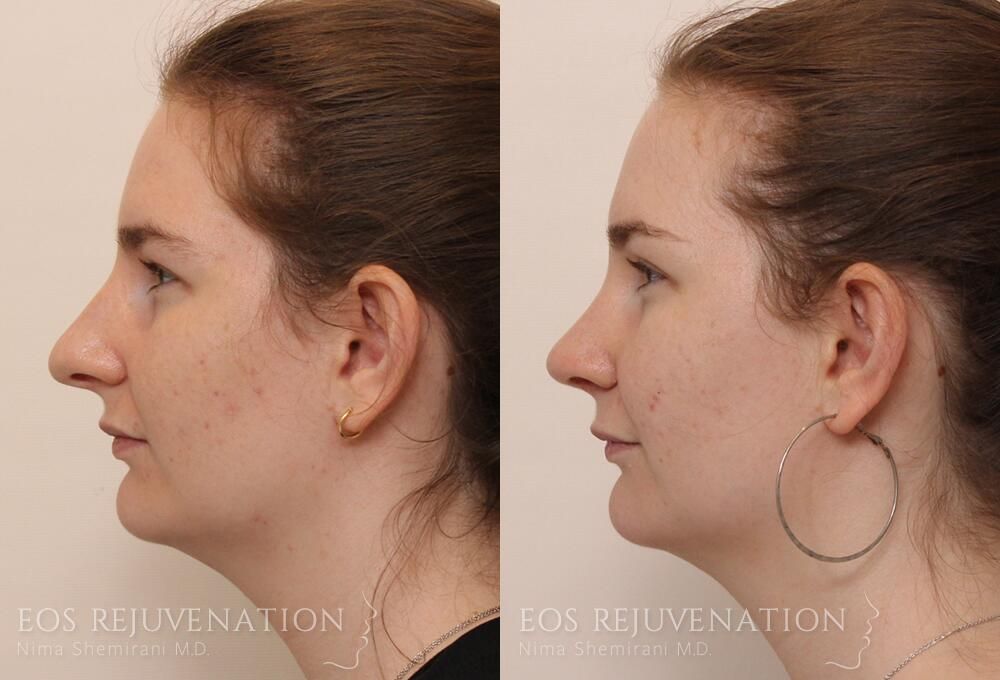 Rhinoplasty Before & After