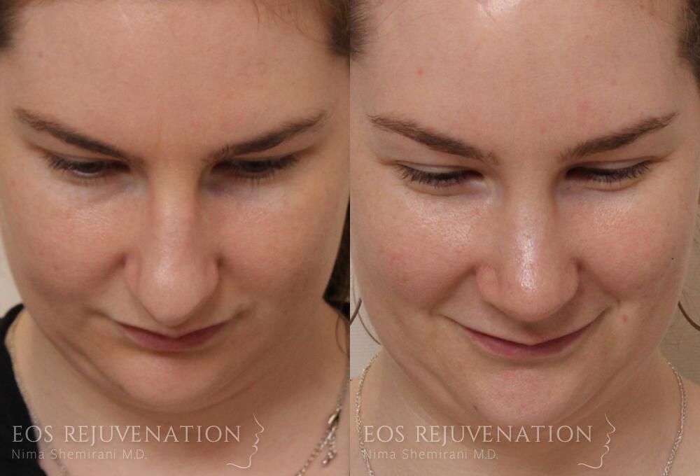 Rhinoplasty Before & After