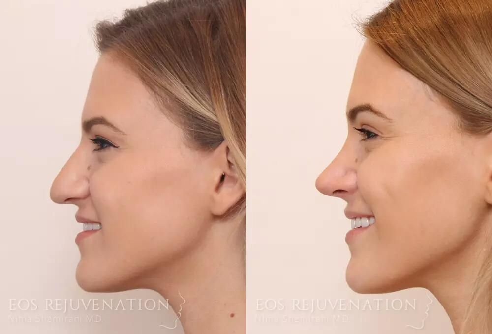 Rhinoplasty Before & After