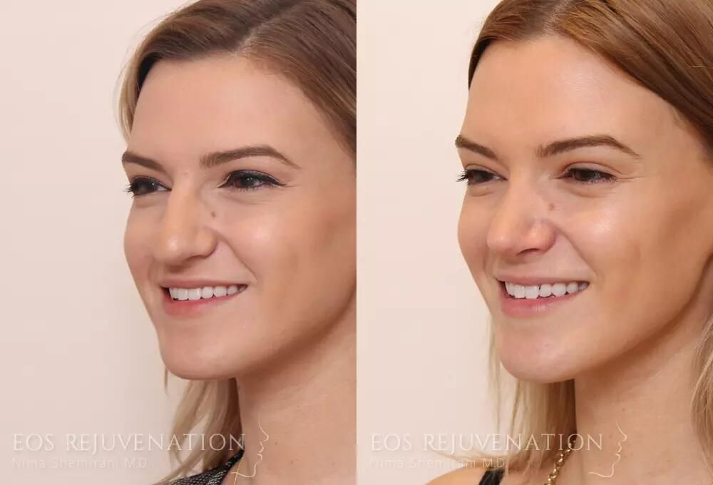 Rhinoplasty Before & After