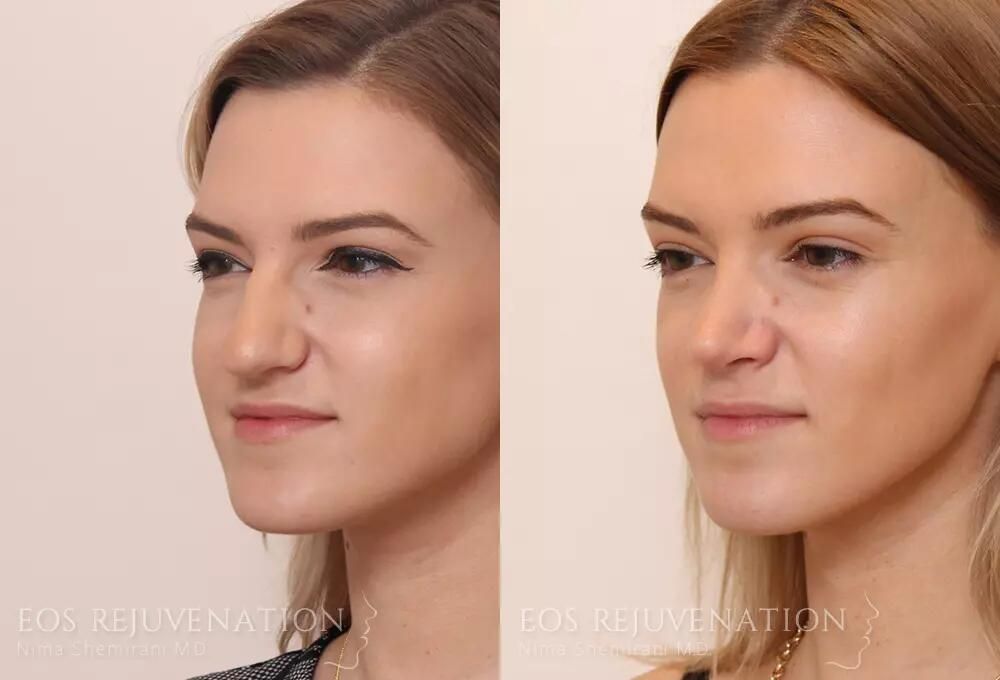 Rhinoplasty Before & After