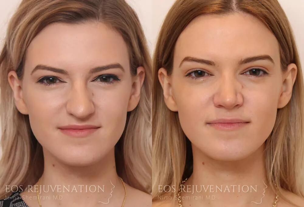 Rhinoplasty Before & After